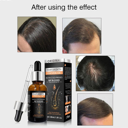 Dermaroller und Haarwachstum Serum Set Bartroller Haarwachstum beschleunigen