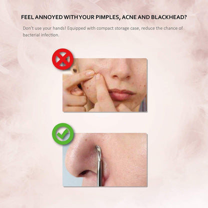 Mitesserentferner Set Edelstahl 6 Stk. Bonus Pinzette