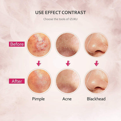 Mitesserentferner Set Edelstahl 6 Stk. Bonus Pinzette