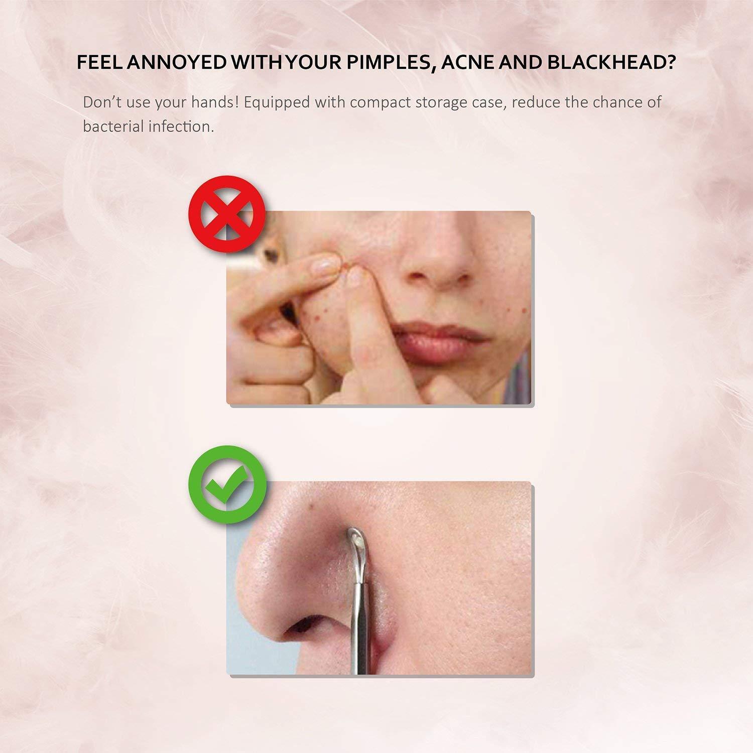 Mitesserentferner Set | Blackhead Remover aus Edelstahl | 6 Stk. Komedonenquetscher Kit