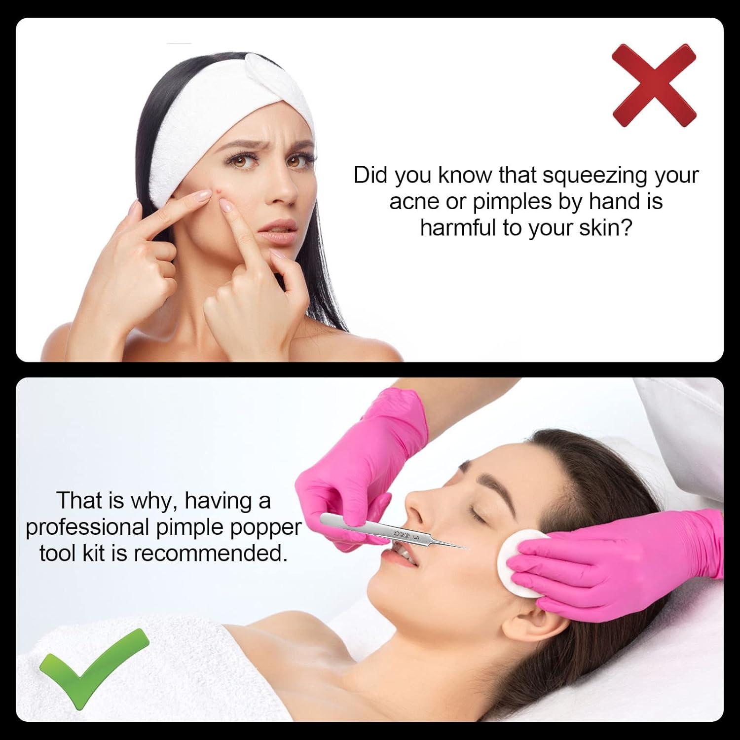 Edelstahl Pinzette Mitesser Entfernung Präzise Akne Flecken