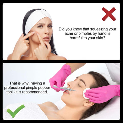 Edelstahl Pinzette Mitesser Entfernung Präzise Akne Flecken