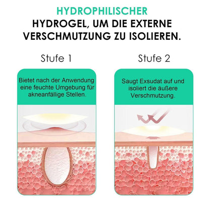 Hydrokolloid Pickel Patches – 264 Stück – Unsichtbar & Wasserfest