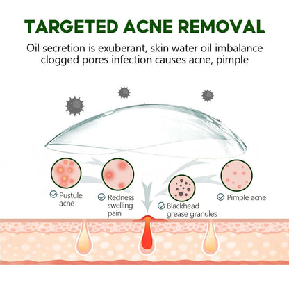 Herbal Anti-Akne Serum und Creme Set Natürliche Pflege