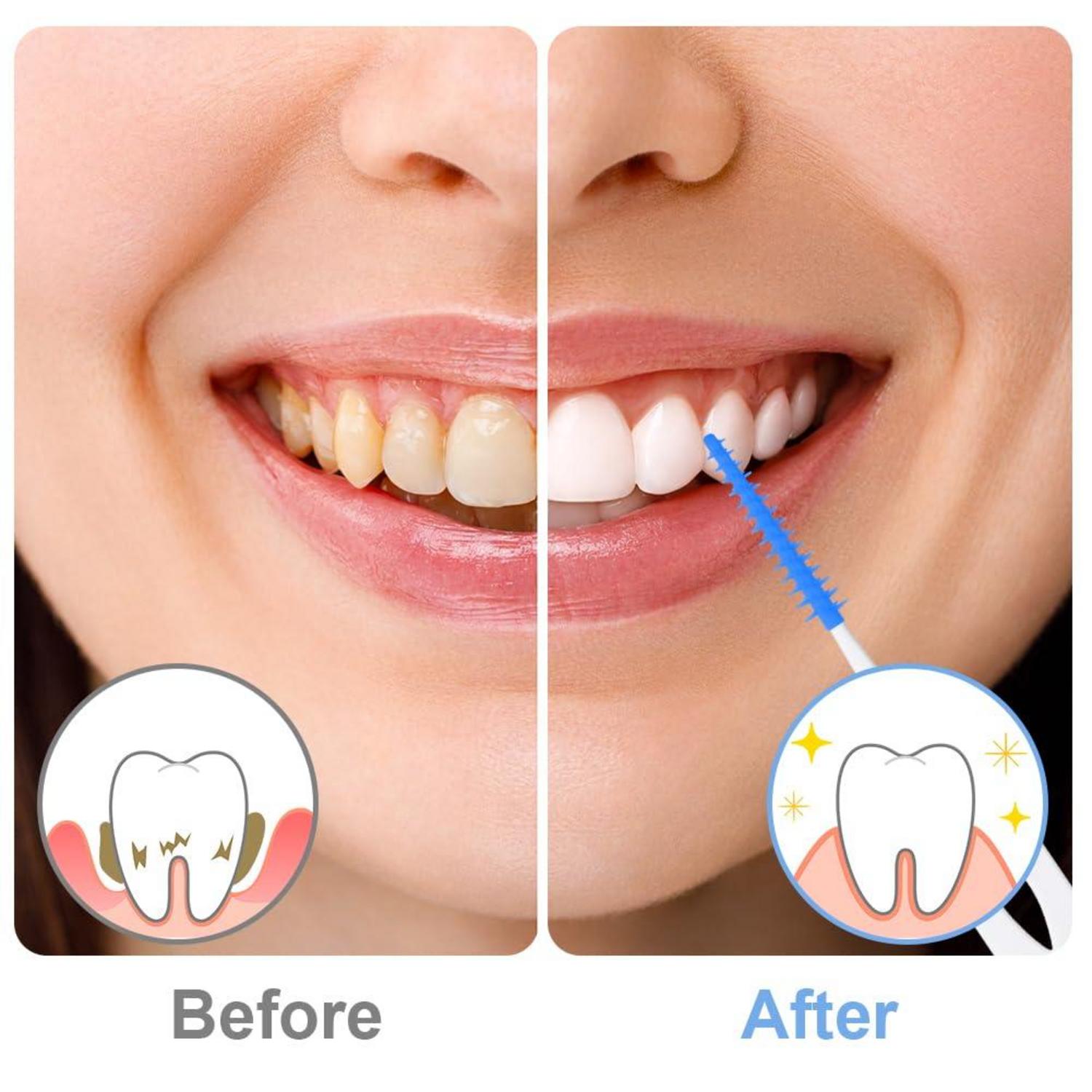 220 Silikon Interdentalbürsten Zahnreinigung Dentalbürsten Blau