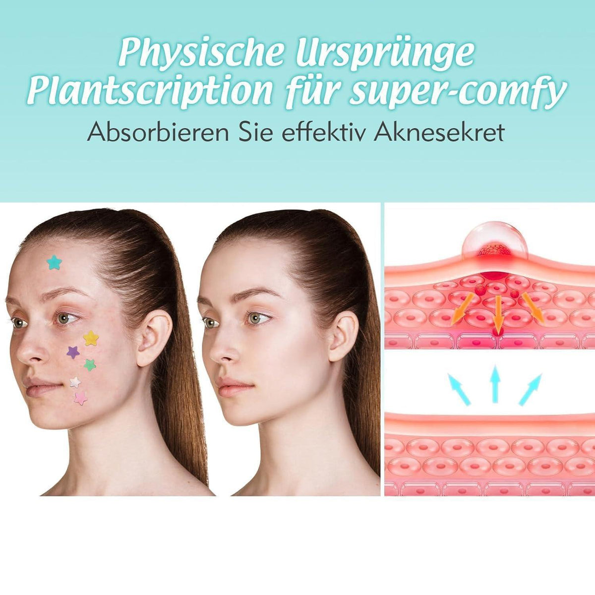 Pickel Patches mit Teebaumöl & Salicylsäure – 240 Stück