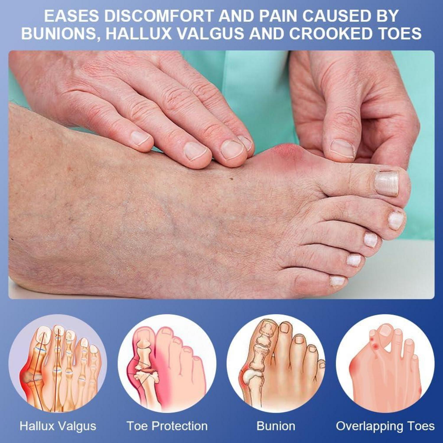 ACWOO Hallux Valgus Korrektur Schiene für Damen und Herren