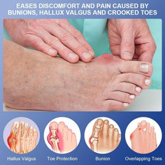 ACWOO Hallux Valgus Korrektur Schiene für Damen und Herren