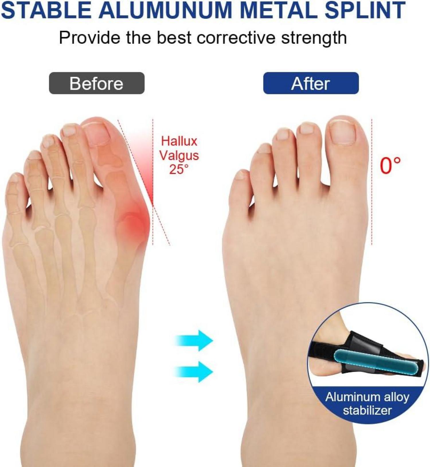 ACWOO Hallux Valgus Korrektur Schiene Set 4-teilig