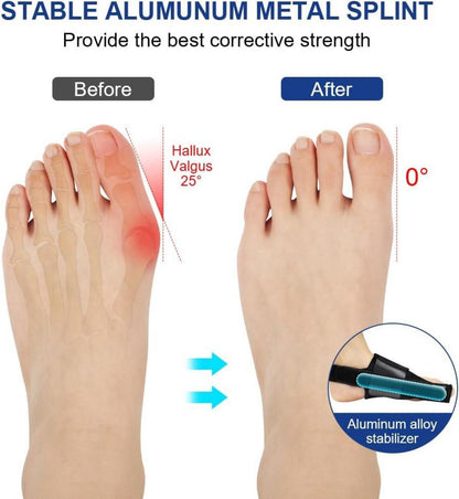 ACWOO Hallux Valgus Korrektur Schiene Set 4-teilig