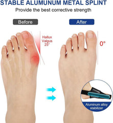 ACWOO Hallux Valgus Korrektur Schiene Set 4-teilig